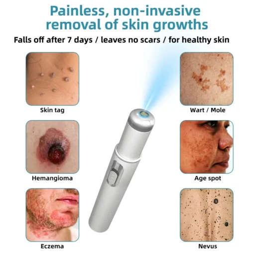 KIDSNEED® Non-invasive Mole & Wart Removal Laser Pen