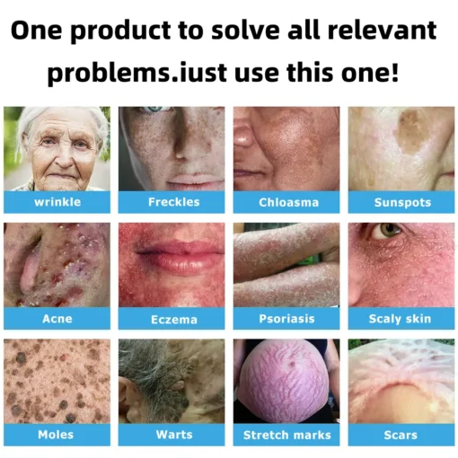 𝑲i𝒅sn𝒆𝒆𝒅® 𝑵on-i𝒏va𝒔𝒊ve 𝑴o𝒍e an𝒅 𝑾ar𝒕 𝑹emo𝒗𝒂𝒍 𝑳ase𝒓 𝑷en